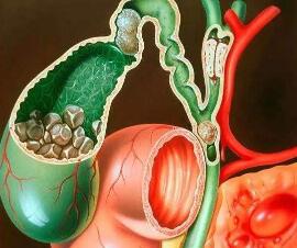 結石性膽囊炎
