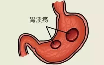 胃潰瘍