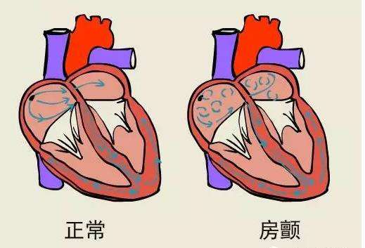 房顫