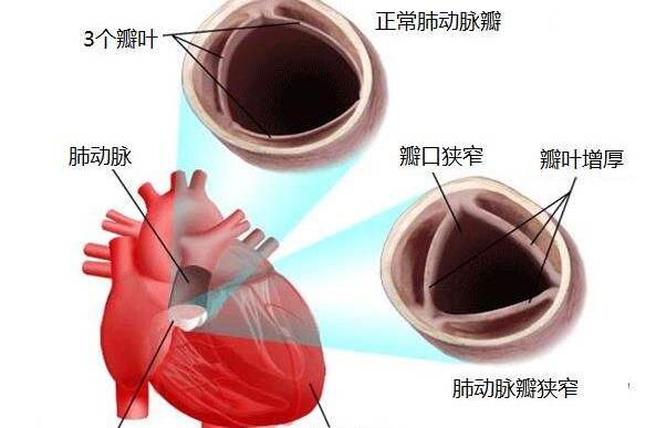 肺動脈狹窄
