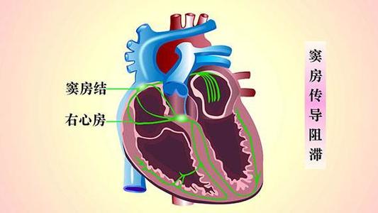 房室傳導阻滯