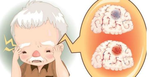 短暫性腦缺血發(fā)作