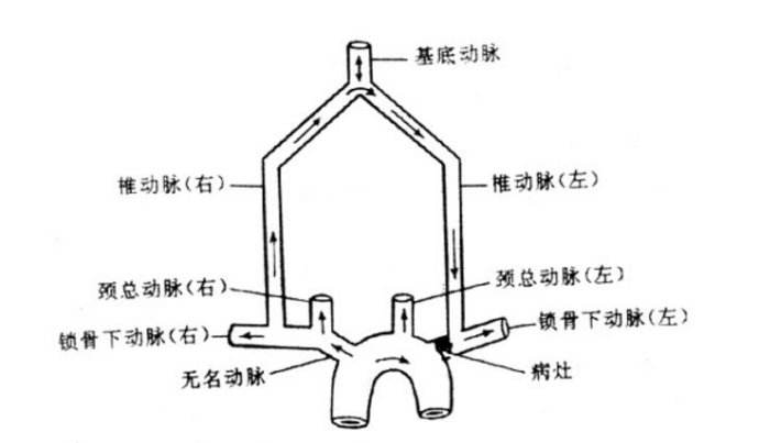 椎-基底動脈盜血綜合征