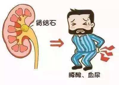 腎結石