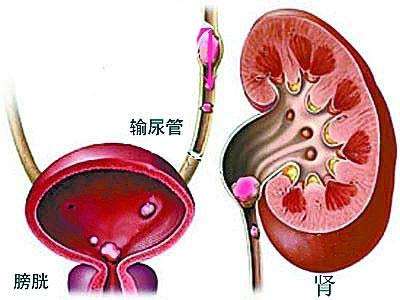 重復腎盂輸尿管畸形