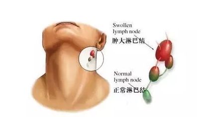 慢性淋巴結炎
