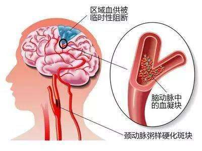 腦動(dòng)脈硬化
