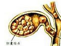 膽結(jié)石