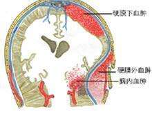 硬腦膜下血腫