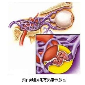 頸動脈海綿竇瘺