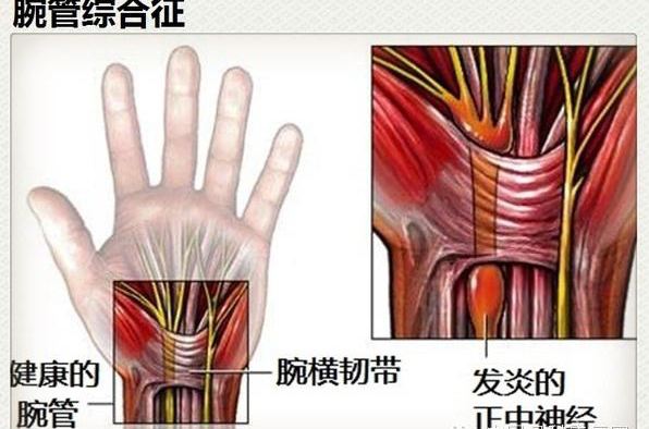 腕管綜合征