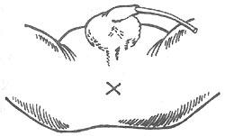 先天性肛門(mén)閉鎖