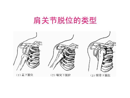 肩關(guān)節(jié)脫位