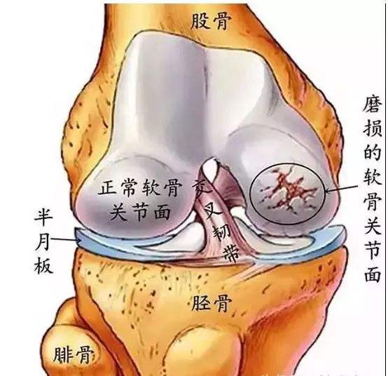 創傷性關節炎