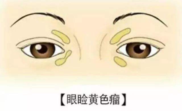 眼瞼黃色瘤