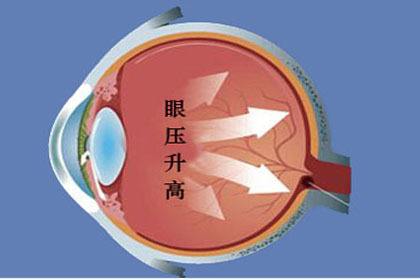 高眼壓癥