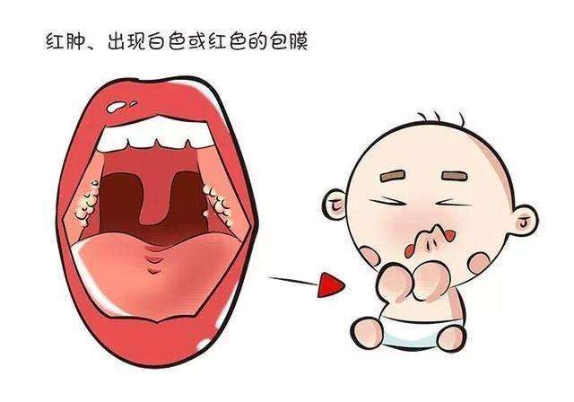 嬰幼兒化膿性淋巴結(jié)炎