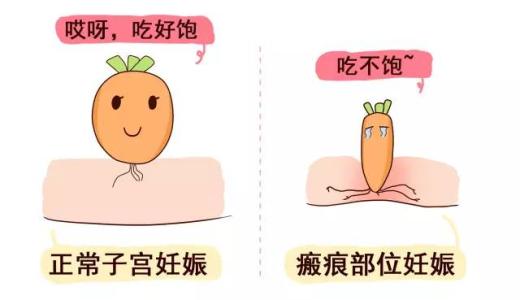 瘢痕子宮
