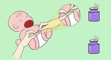 新生兒臍肉芽腫