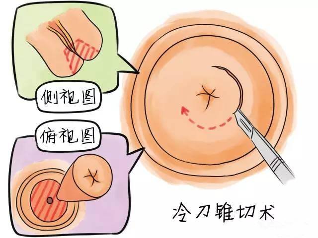 宮頸錐切術