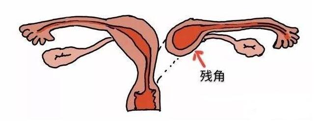 子宮殘角妊娠