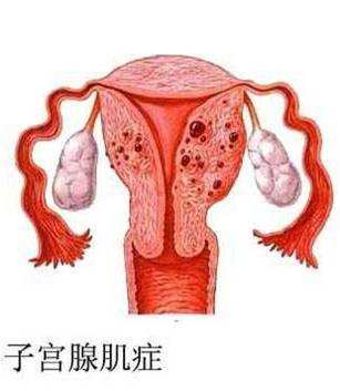 子宮腺肌癥