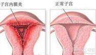 子宮內膜炎